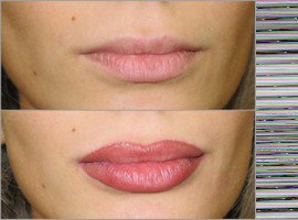 Удаление татуажа губ