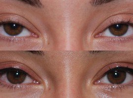 Удаление татуажа на веке, только стрелка (обе)