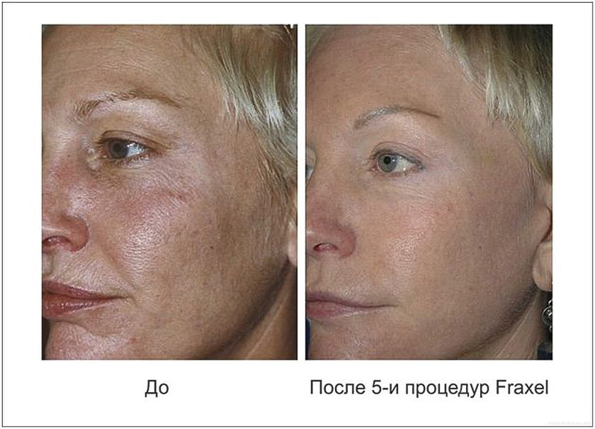 Fraxel_5