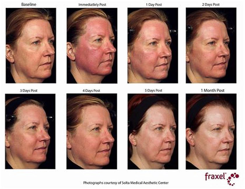 Fraxel_6