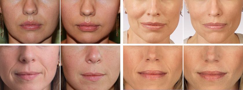 CounturPlastciNosoGub3